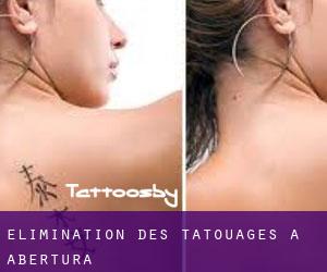 Élimination des tatouages à Abertura