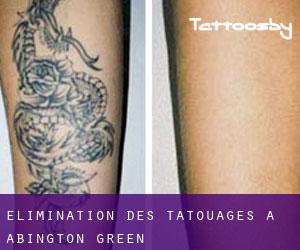 Élimination des tatouages à Abington Green