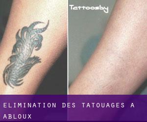 Élimination des tatouages à Abloux