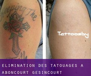 Élimination des tatouages à Aboncourt-Gesincourt