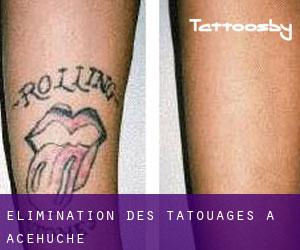 Élimination des tatouages à Acehúche