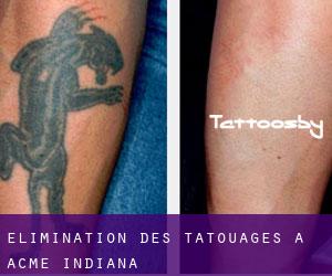Élimination des tatouages à Acme (Indiana)