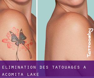 Élimination des tatouages à Acomita Lake