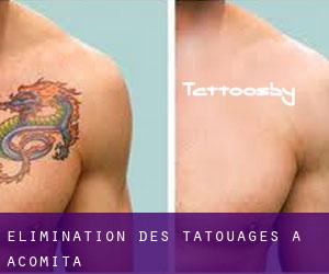 Élimination des tatouages à Acomita