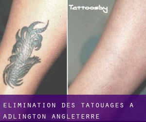 Élimination des tatouages à Adlington (Angleterre)