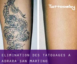 Élimination des tatouages à Adrara San Martino