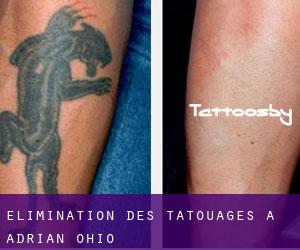 Élimination des tatouages à Adrian (Ohio)