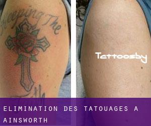 Élimination des tatouages à Ainsworth