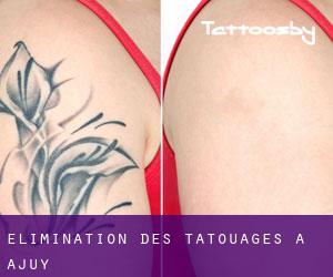 Élimination des tatouages à Ajuy