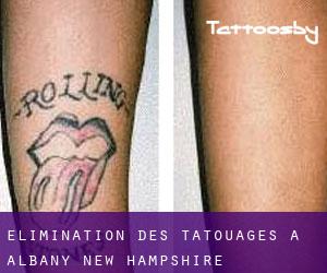 Élimination des tatouages à Albany (New Hampshire)