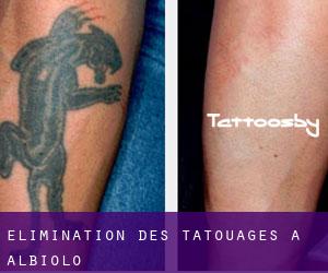 Élimination des tatouages à Albiolo