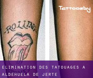 Élimination des tatouages à Aldehuela de Jerte