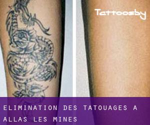 Élimination des tatouages à Allas-les-Mines