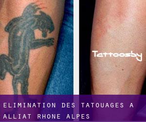 Élimination des tatouages à Alliat (Rhône-Alpes)