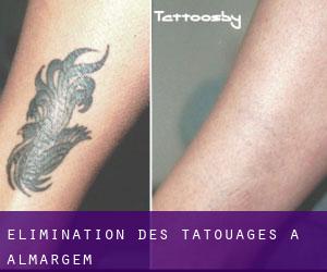 Élimination des tatouages à Almargem