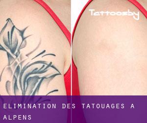 Élimination des tatouages à Alpens