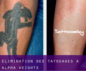 Élimination des tatouages à Alpha Heights