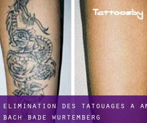 Élimination des tatouages à Am Bach (Bade-Wurtemberg)