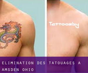 Élimination des tatouages à Amsden (Ohio)