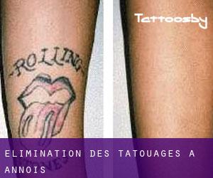 Élimination des tatouages à Annois