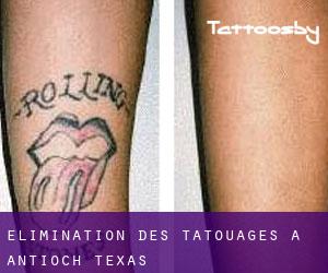Élimination des tatouages à Antioch (Texas)
