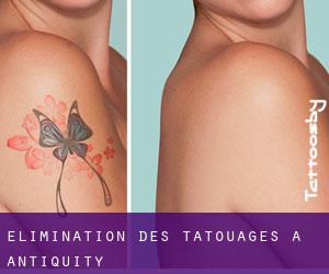 Élimination des tatouages à Antiquity