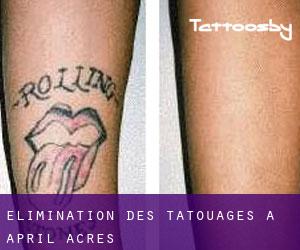 Élimination des tatouages à April Acres