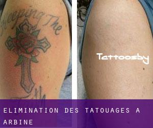 Élimination des tatouages à Arbine