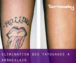 Élimination des tatouages à Ardheslaig
