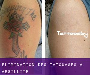 Élimination des tatouages à Argillite