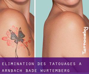 Élimination des tatouages à Arnbach (Bade-Wurtemberg)