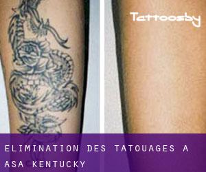 Élimination des tatouages à Asa (Kentucky)