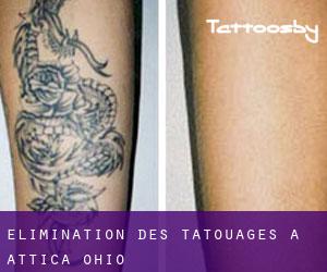 Élimination des tatouages à Attica (Ohio)