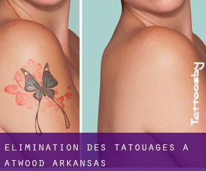 Élimination des tatouages à Atwood (Arkansas)