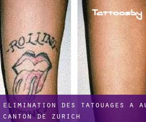 Élimination des tatouages à Au (Canton de Zurich)