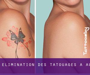 Élimination des tatouages à Au