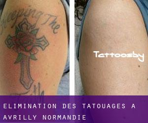 Élimination des tatouages à Avrilly (Normandie)