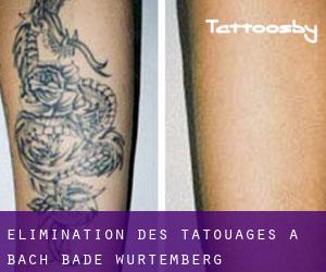 Élimination des tatouages à Bach (Bade-Wurtemberg)