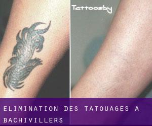 Élimination des tatouages à Bachivillers