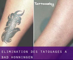 Élimination des tatouages à Bad Hönningen