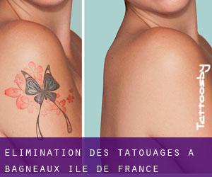 Élimination des tatouages à Bagneaux (Île-de-France)