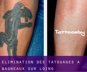 Élimination des tatouages à Bagneaux-sur-Loing