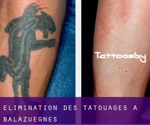 Élimination des tatouages à Balazuègnes