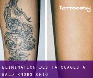 Élimination des tatouages à Bald Knobs (Ohio)