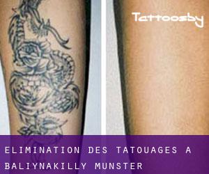 Élimination des tatouages à Baliynakilly (Munster)