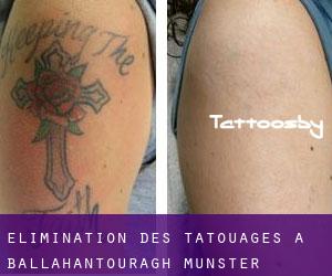 Élimination des tatouages à Ballahantouragh (Munster)