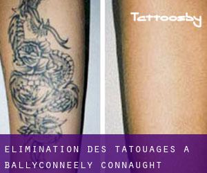 Élimination des tatouages à Ballyconneely (Connaught)