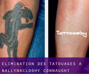 Élimination des tatouages à Ballynacloghy (Connaught)