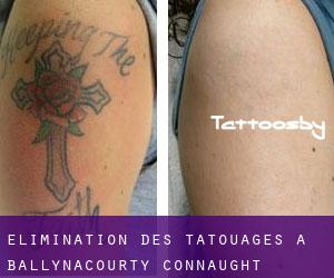 Élimination des tatouages à Ballynacourty (Connaught)