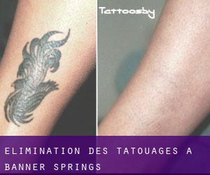 Élimination des tatouages à Banner Springs